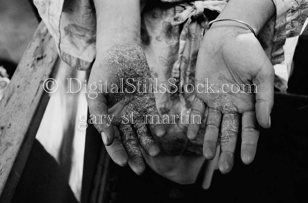 Hands with Eczema Close Up Analog, Portraits, Women, B & W