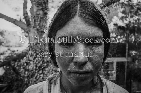Close Up of Caroline Mid Eczema Flare Up Analog, Portraits, Women, B & W